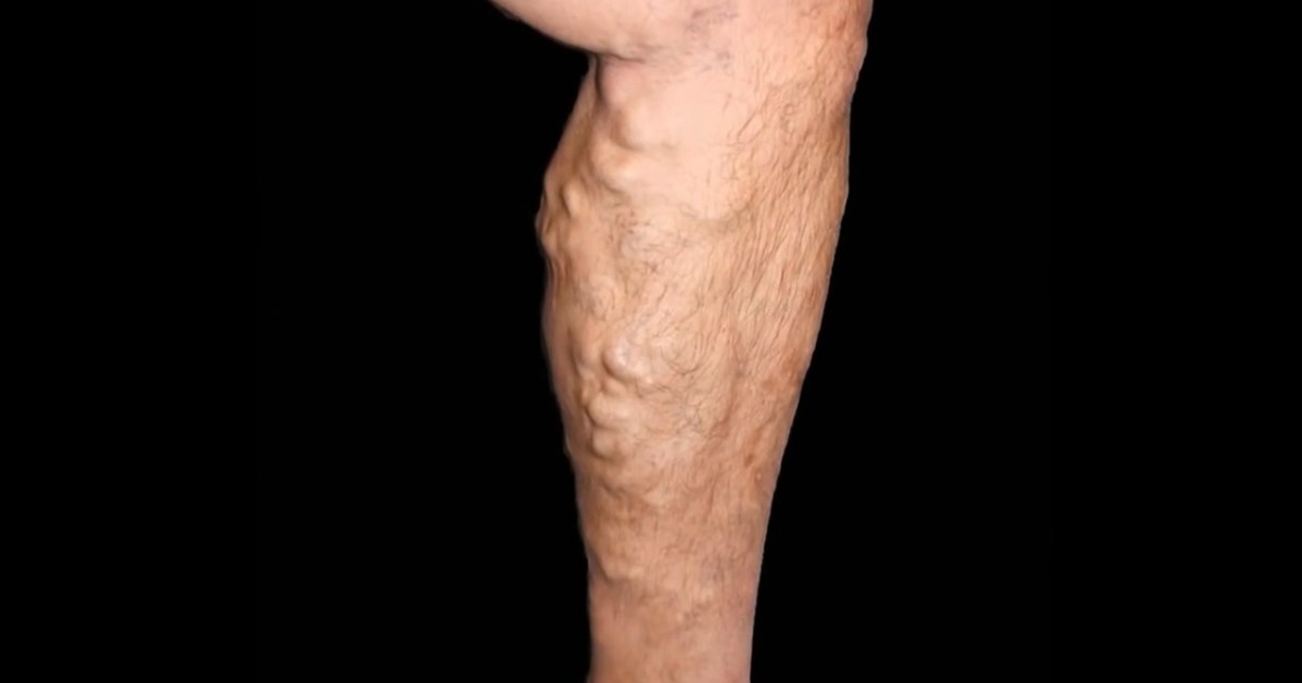 What do you know about blood clotting?