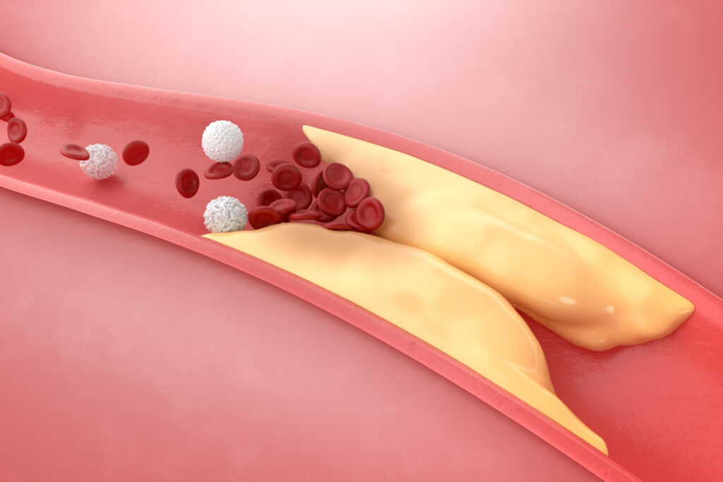 How to lower blood cholesterol without medications?