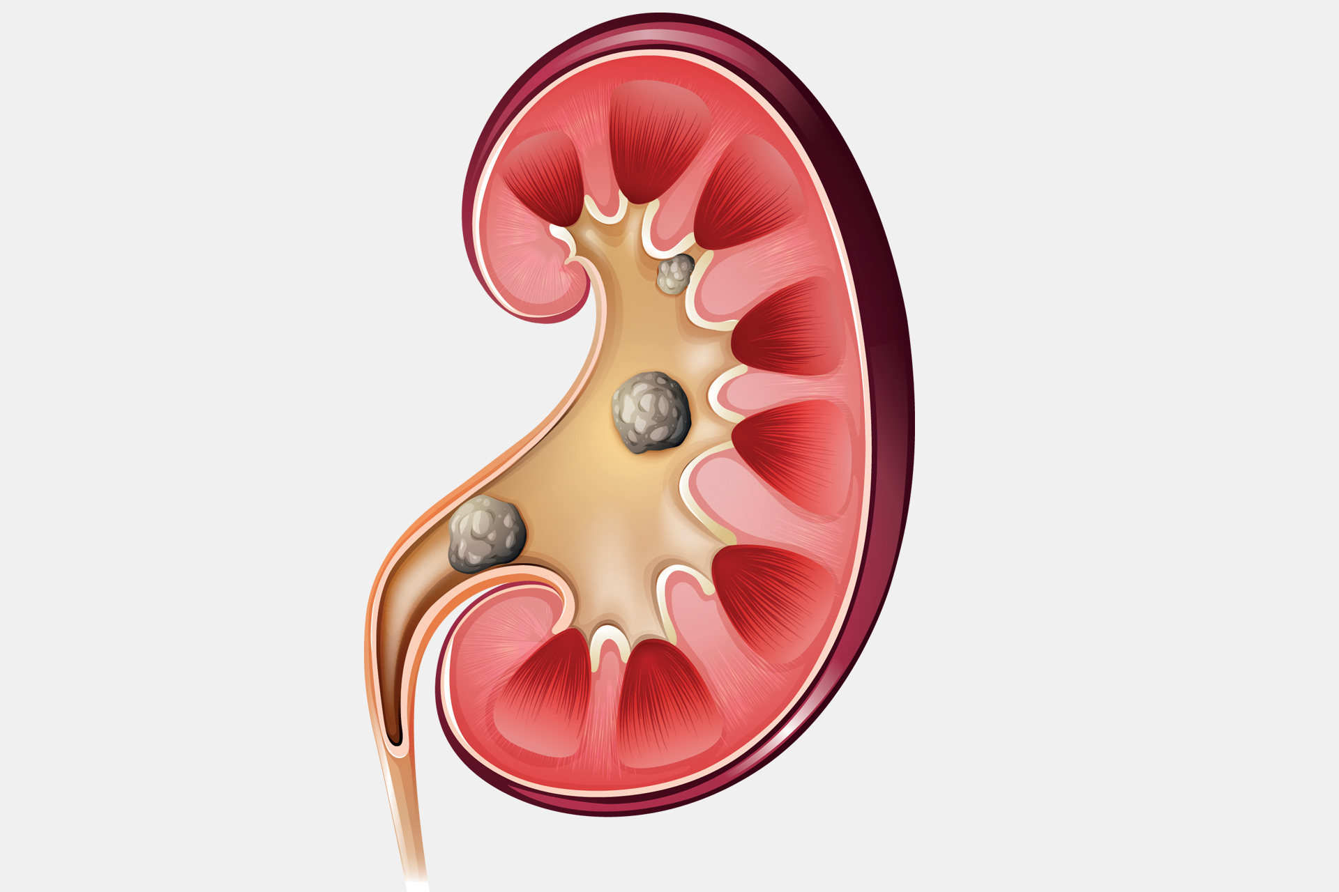 Chronic kidney disease has become a global health crisis according to a recent study