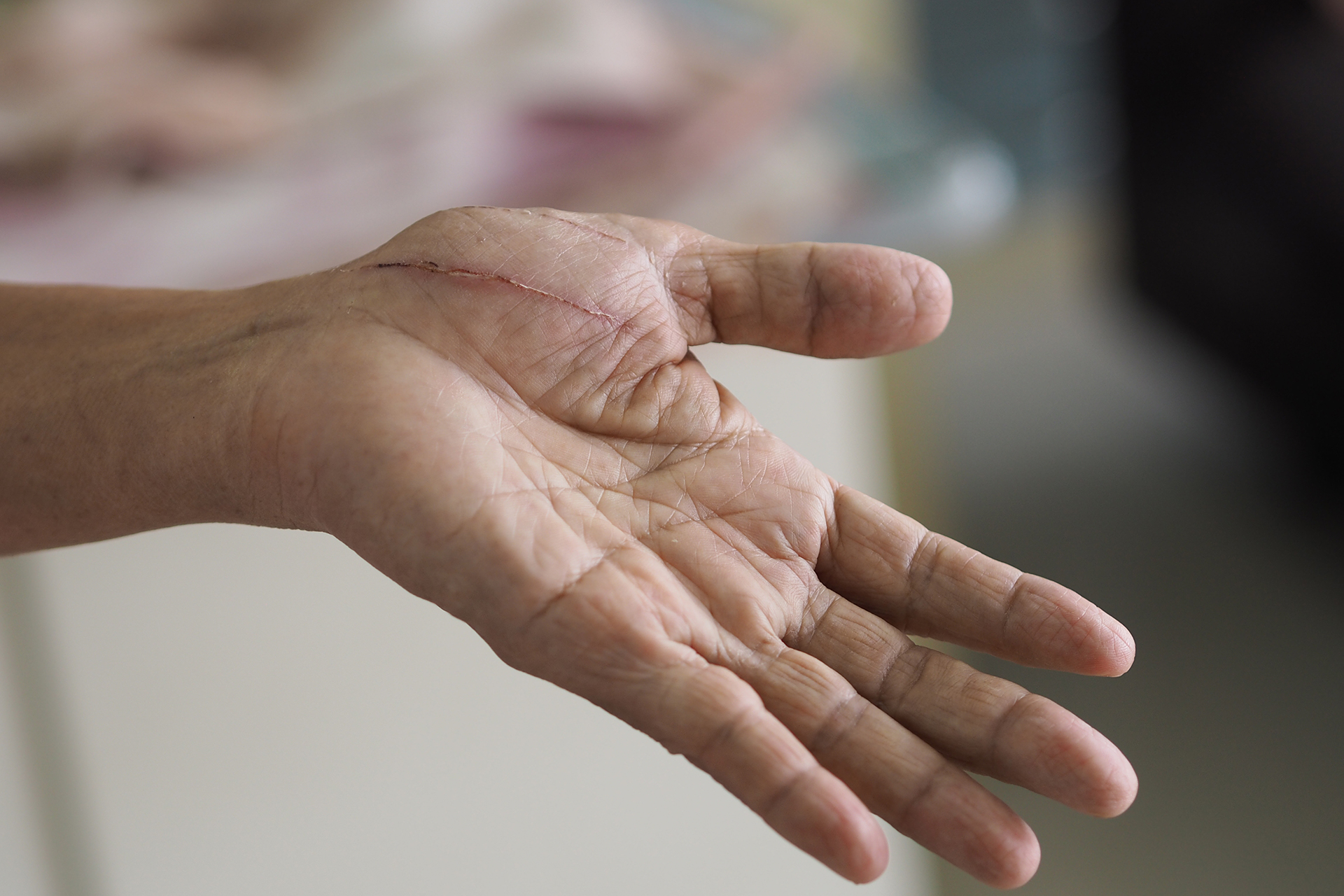 Does the appearance of the scar bother you? Here's the solution