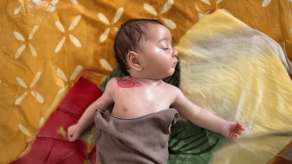 Palestinian Ministry of Health: Six thousand people who had their legs or one of their limbs amputated need urgent rehabilitation programs