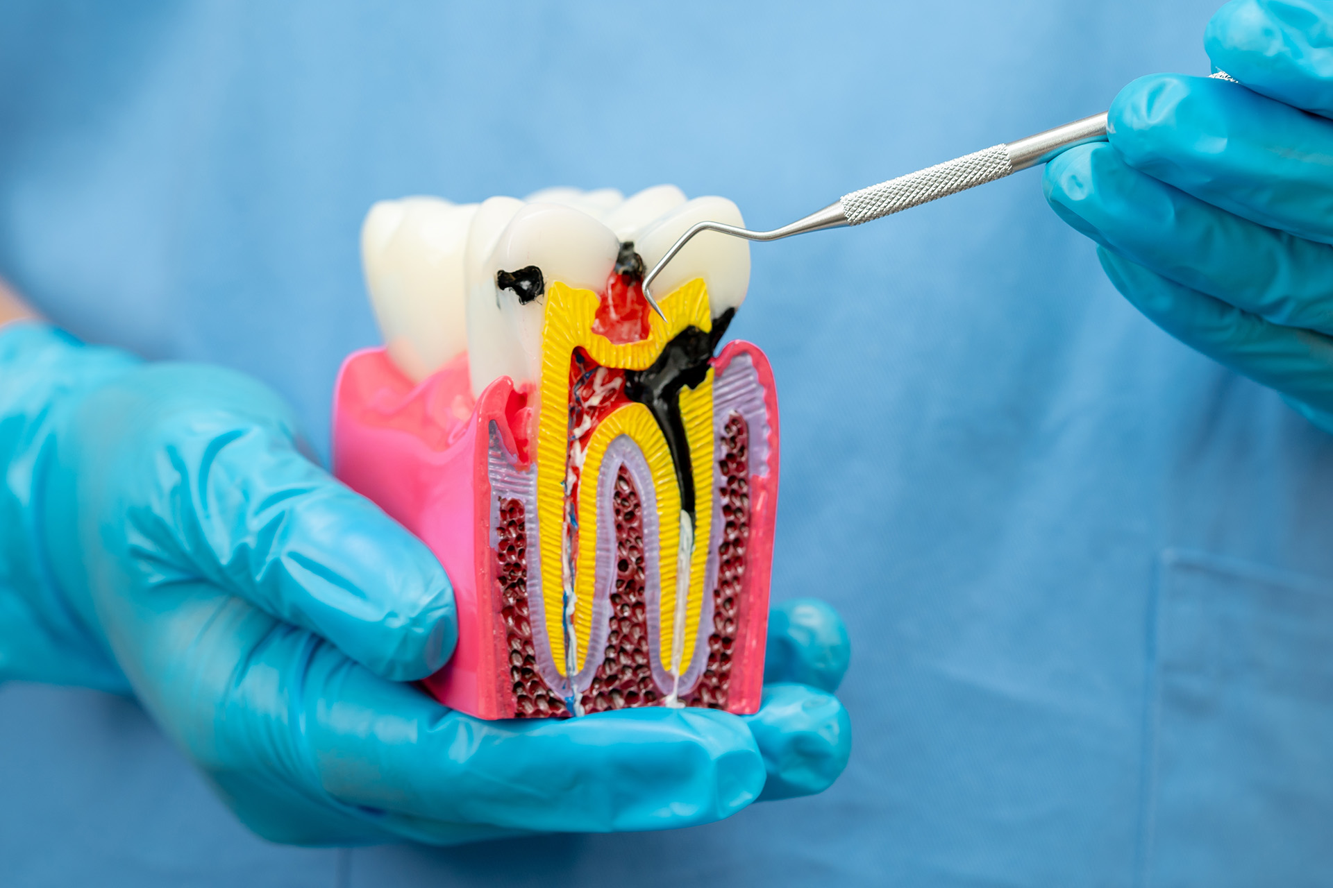 Root canal treatment reduces the risk of heart disease and diabetes