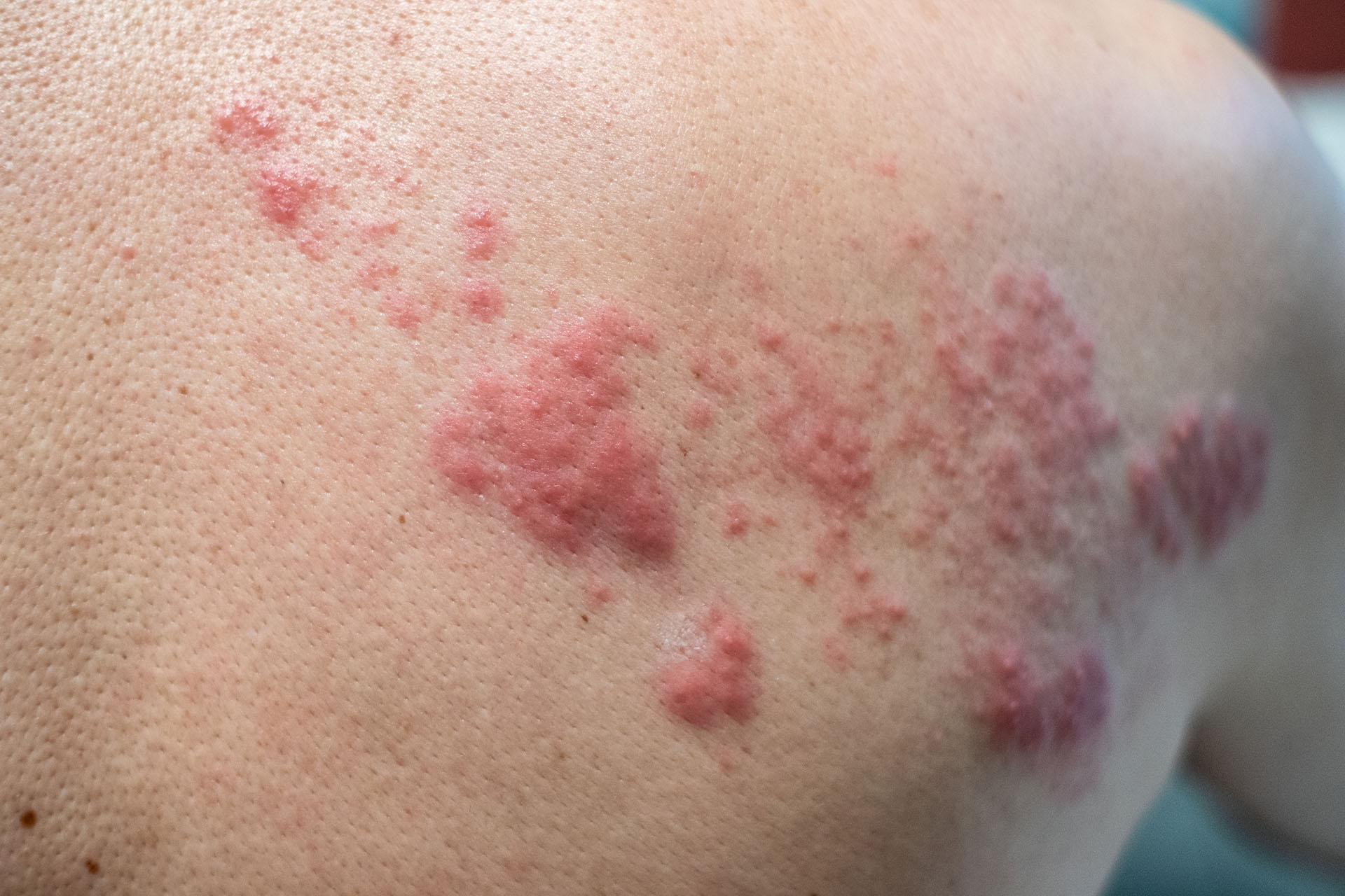 Vaccination against herpes zoster is important for these people