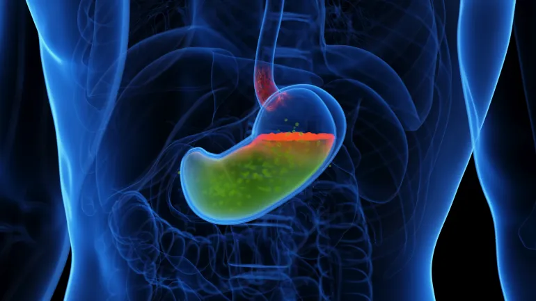 Gastroesophageal reflux disease, illustration