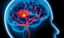 Early steps may protect you from stroke for life