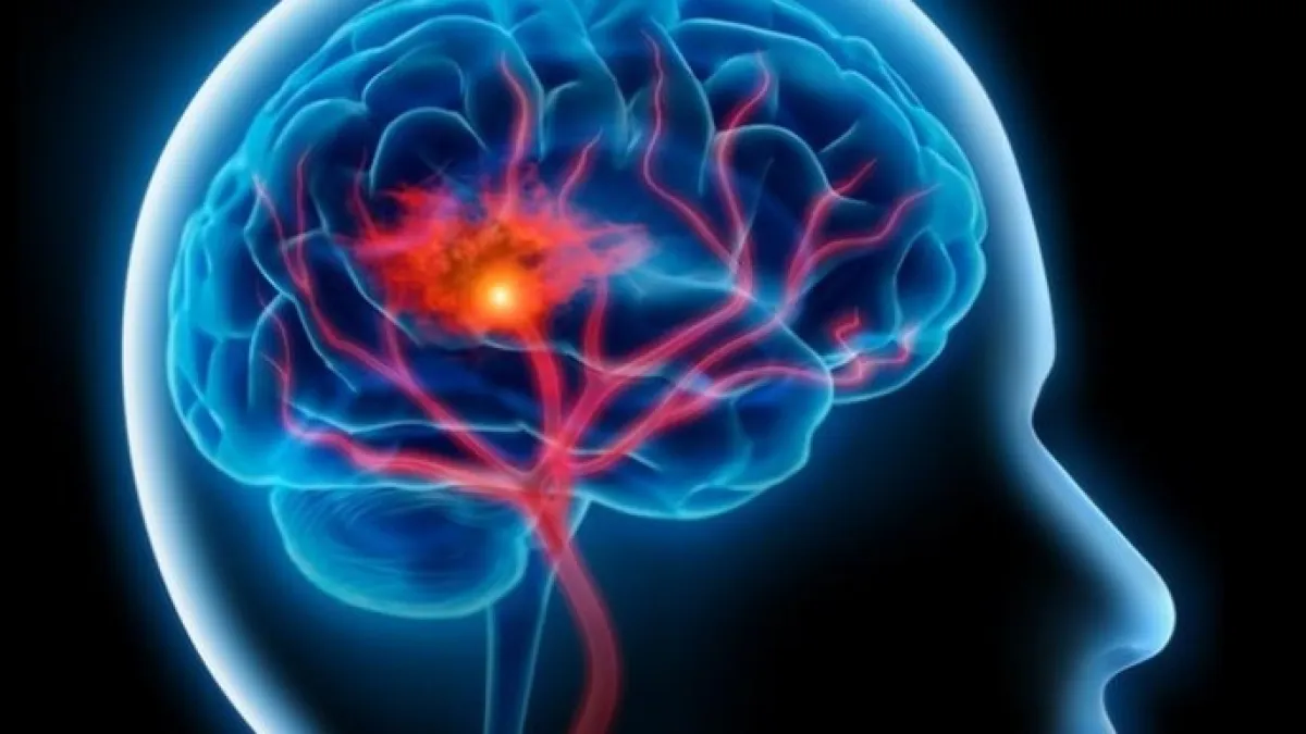 Early steps may protect you from stroke for life