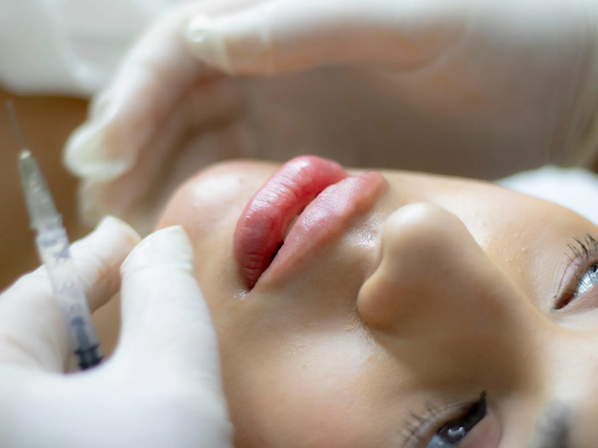 Hyaluronic acid injections for the face...a secret to freshness or a cosmetic exaggeration?