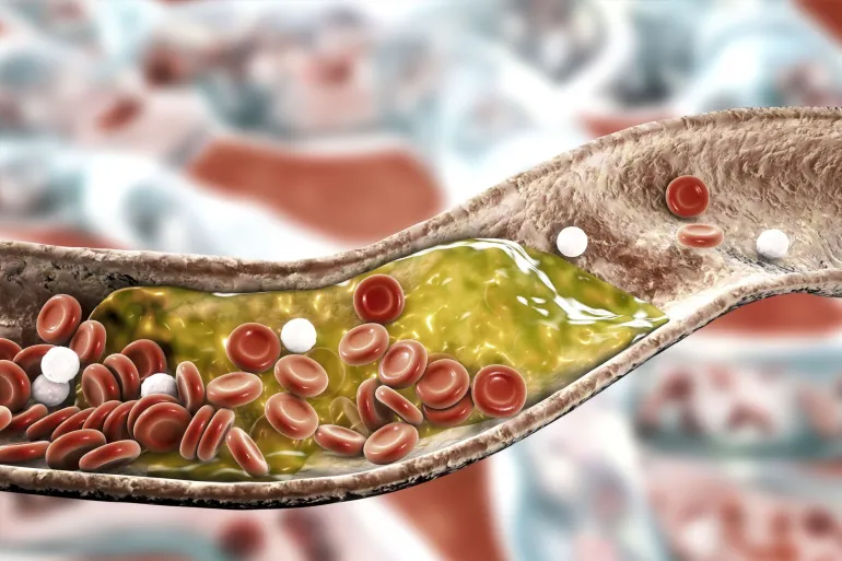 In 30 a day at home how to lower cholesterol without medications