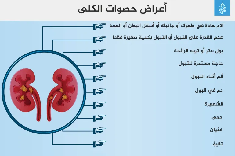 Infographic Symptoms of Kidney Stones Kidney Stones Kidney Stones Kidney Stones Kidney Kidney Kidney Two Kidneys