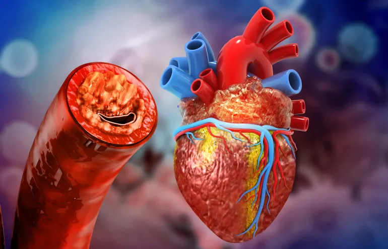 Human heart anatomy and clogged arteries. 3d illustration cholesterol