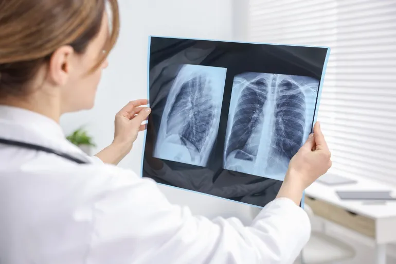 Doctor examines lungs x-ray in hospital, closeup; Shutterstock ID 2609918125; purchase_order: aj; job: ; client: ; other: