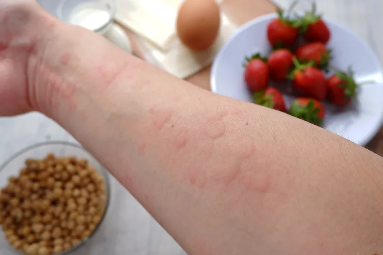 Close up image of arm suffering severe urticaria or hives or kaligata with illustration of allergy trigger foods. Eggs, milk, beans, strawberry, and ... See More by wisely @Adobe Stock