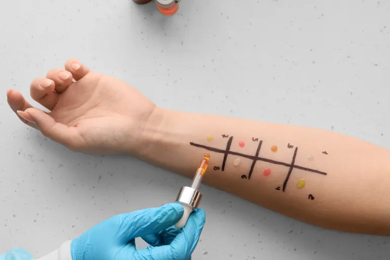 Doctor with dropper making allergy skin test on patient's hand in clinic, closeup by Pixel-Shot @Adobe Stock