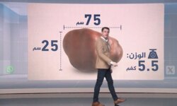 5.5 kilograms, the weight of a tumor in the neck…a rare resection in Sudan that occupies the platforms