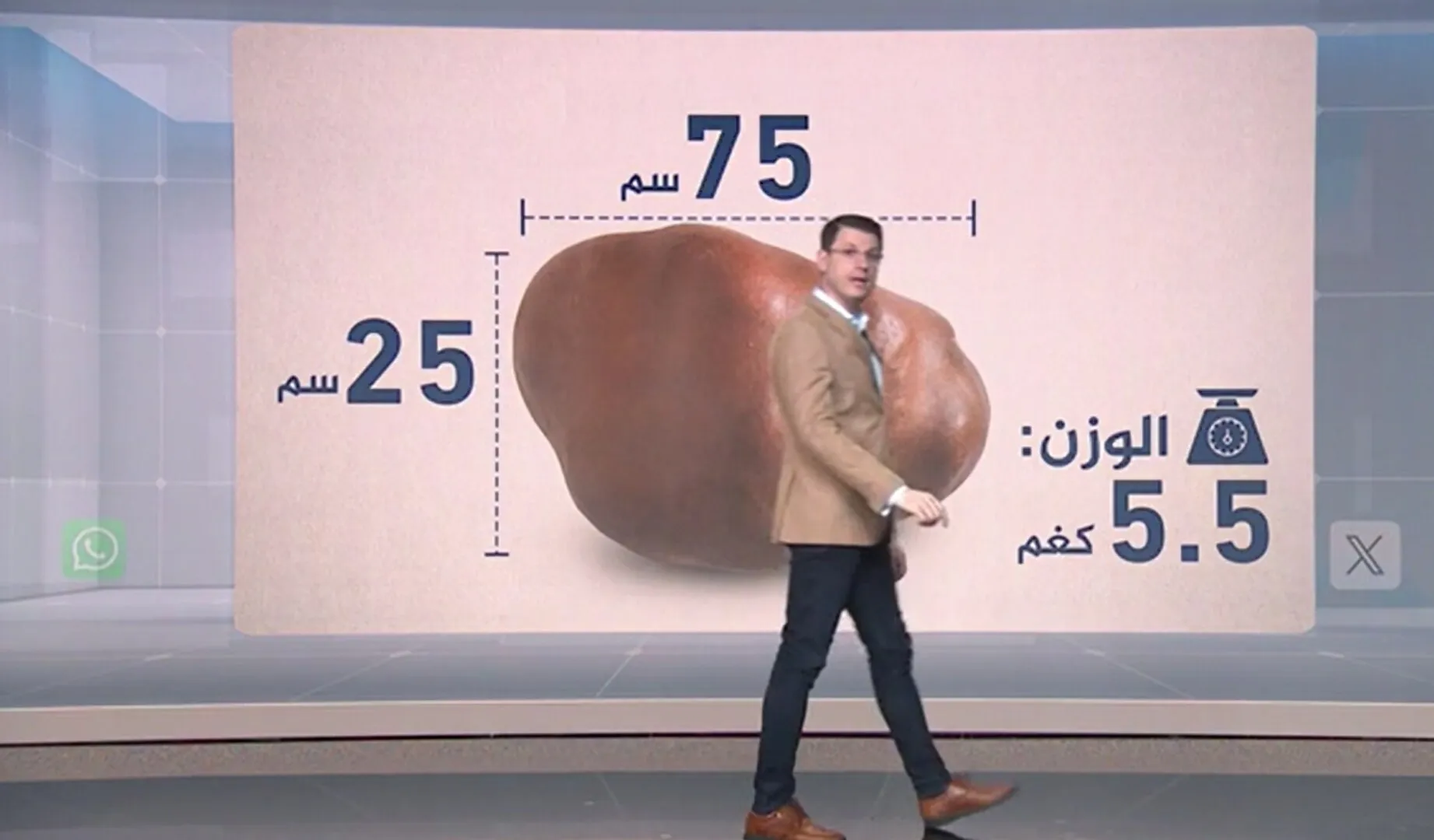 5.5 kilograms, the weight of a tumor in the neck...a rare resection in Sudan that occupies the platforms