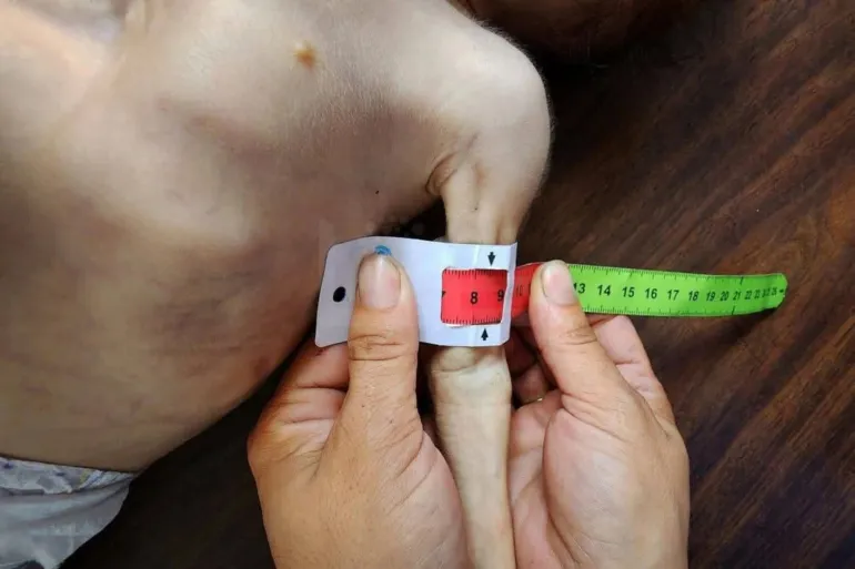 Children suffering from malnutrition during a medical examination in Gaza (Palestinian Press Agency)