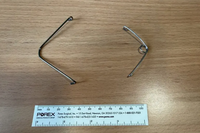 “Ultra-elastic” springs reshape the skull of a British child in a world first Source: Great Ormond Street Hospital for Children website