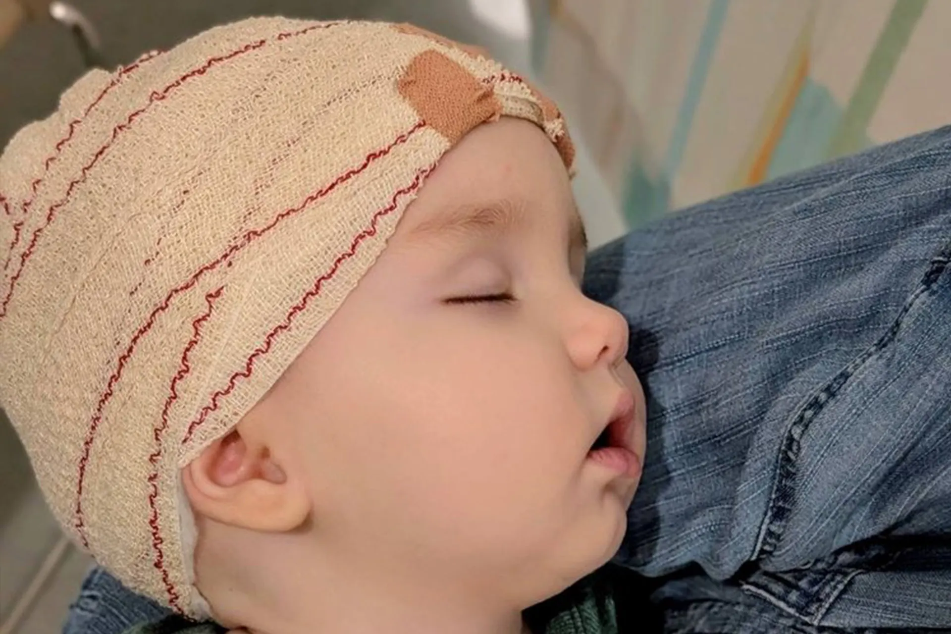 Springs inside a child's skull...a global precedent that reshapes his head