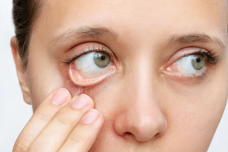 Cropped shot of a young caucasian woman showing off her pale conjunctiva isolated on a white background. Iron deficiency anemia. Reduced hemoglobin by Adobe Stock