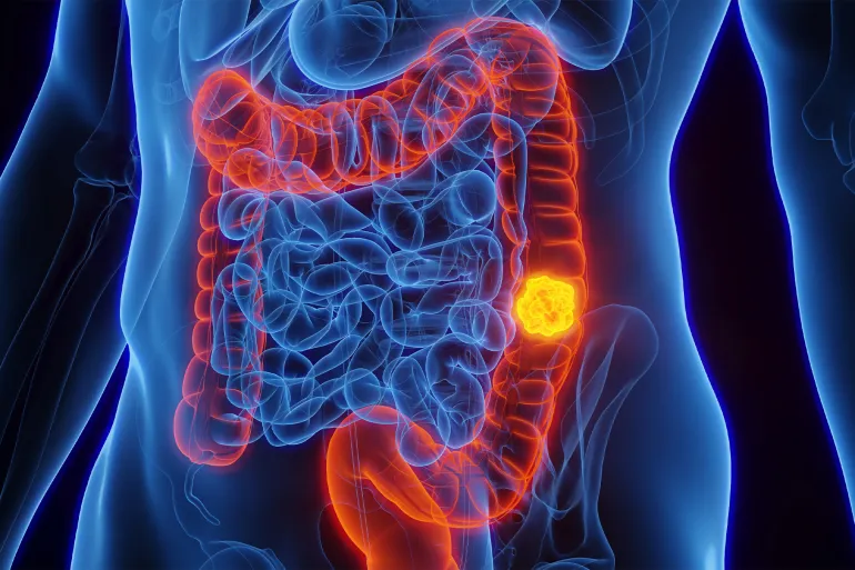 3D rendered Medical Illustration of Male Anatomy - Colon Cancer; Descending Colon. Source: AdobeStock