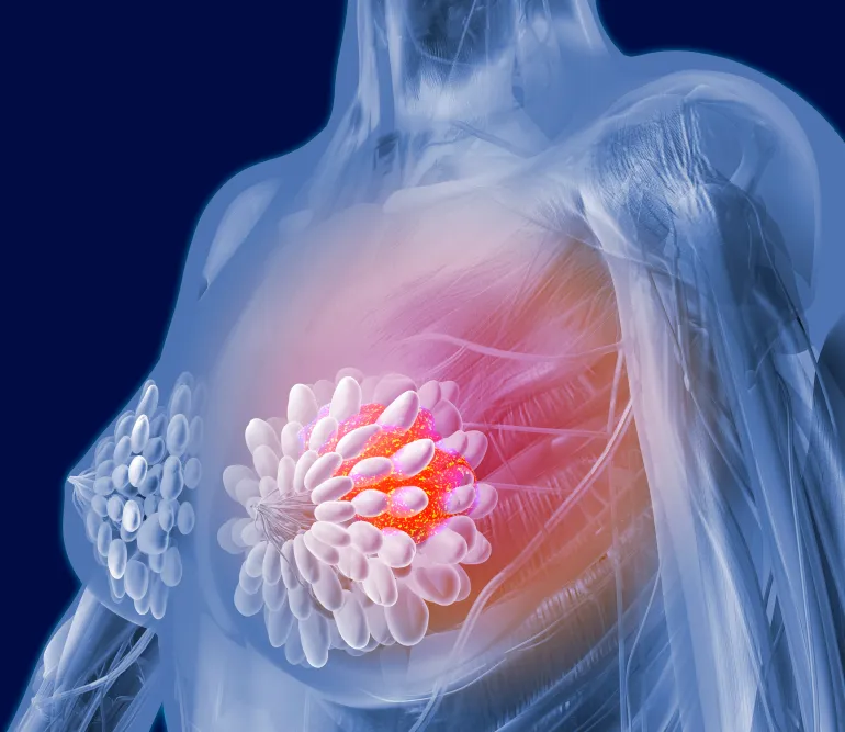 Most cases of breast pain are associated with benign causes and do not necessarily mean cancer