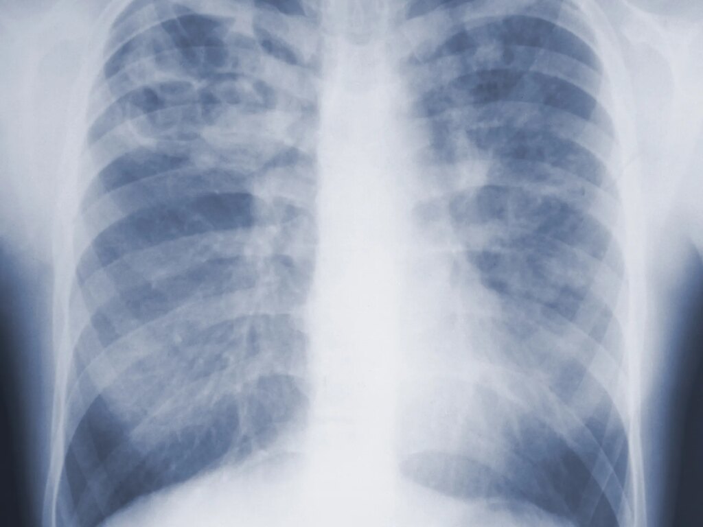 A new drug slows the deterioration of lung fibrosis... and a surprise in the results of the doses