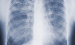 A new drug slows the deterioration of lung fibrosis… and a surprise in the results of the doses