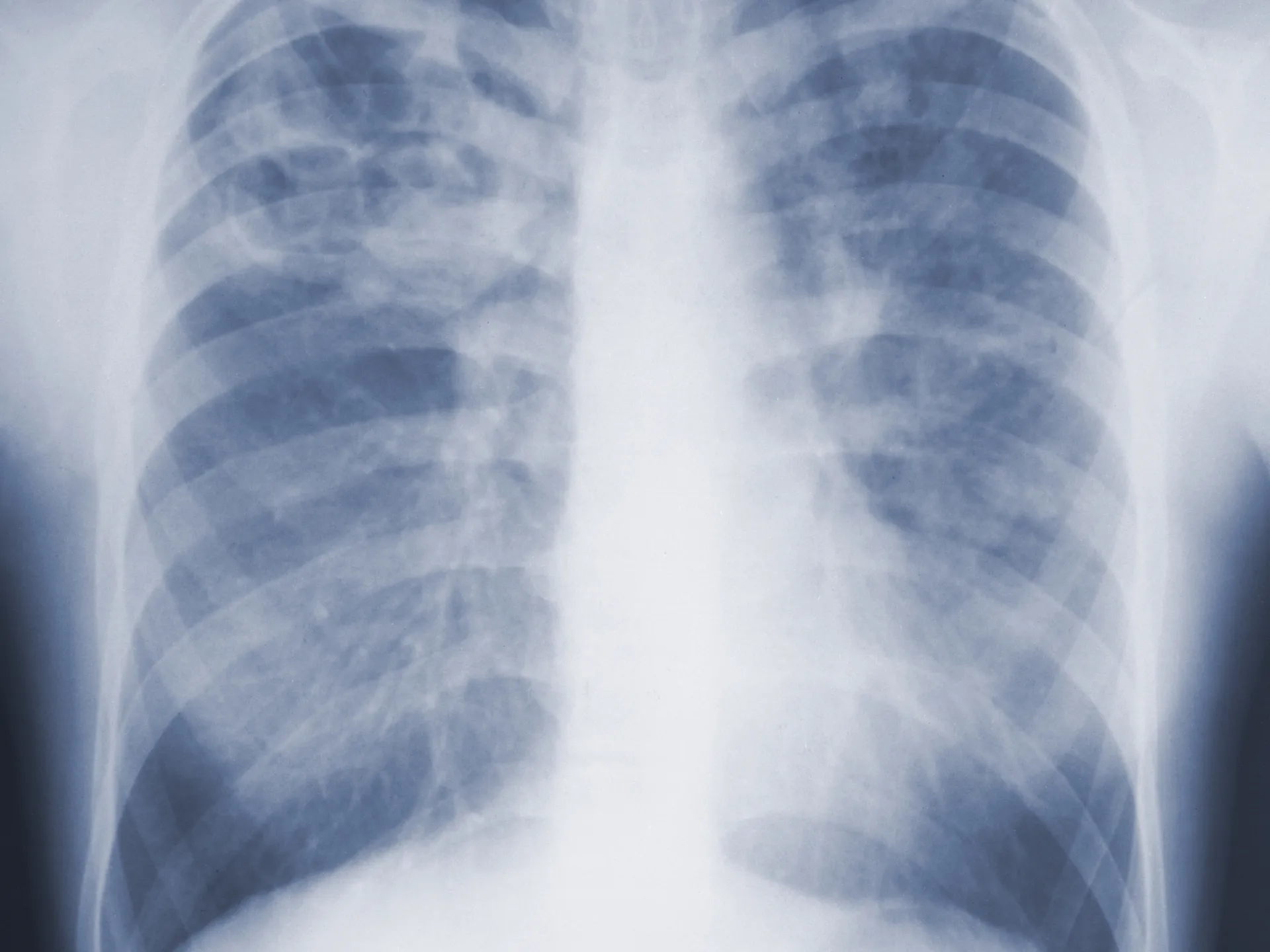 A new drug slows the deterioration of lung fibrosis... and a surprise in the results of the doses