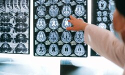 A rare fungus attacks the brain…worrying infections and deaths reach 70%