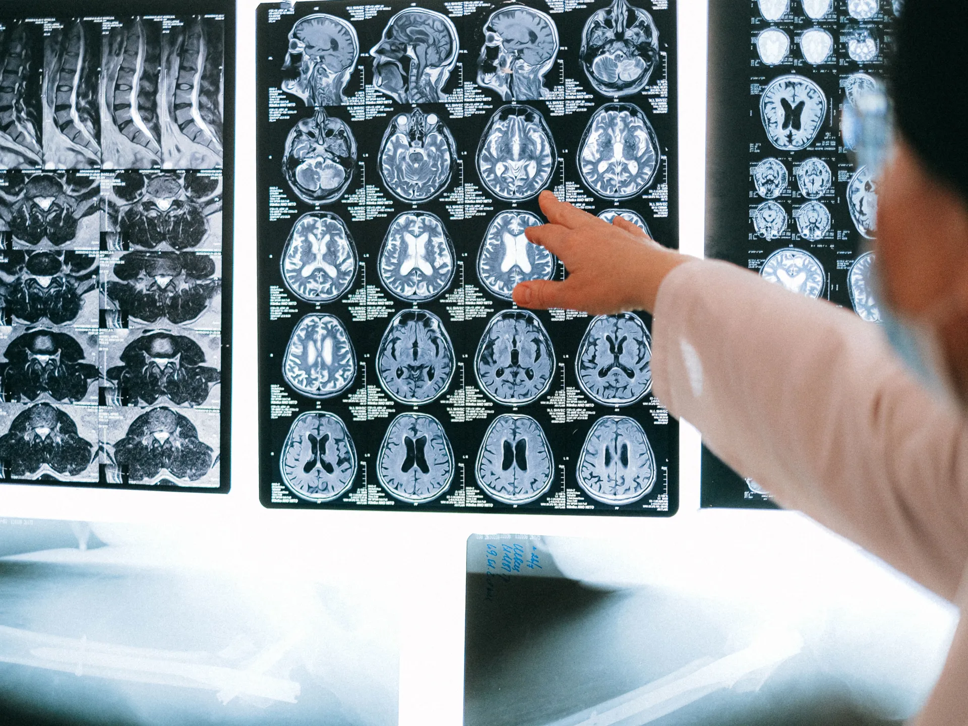 A rare fungus attacks the brain...worrying infections and deaths reach 70%
