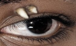 A tooth protrudes from a teenager’s eyelid…a rare condition that baffles doctors