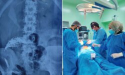 Trauma in the gut of an Iraqi…a complex surgery to extract 214 needles and pins from his stomach