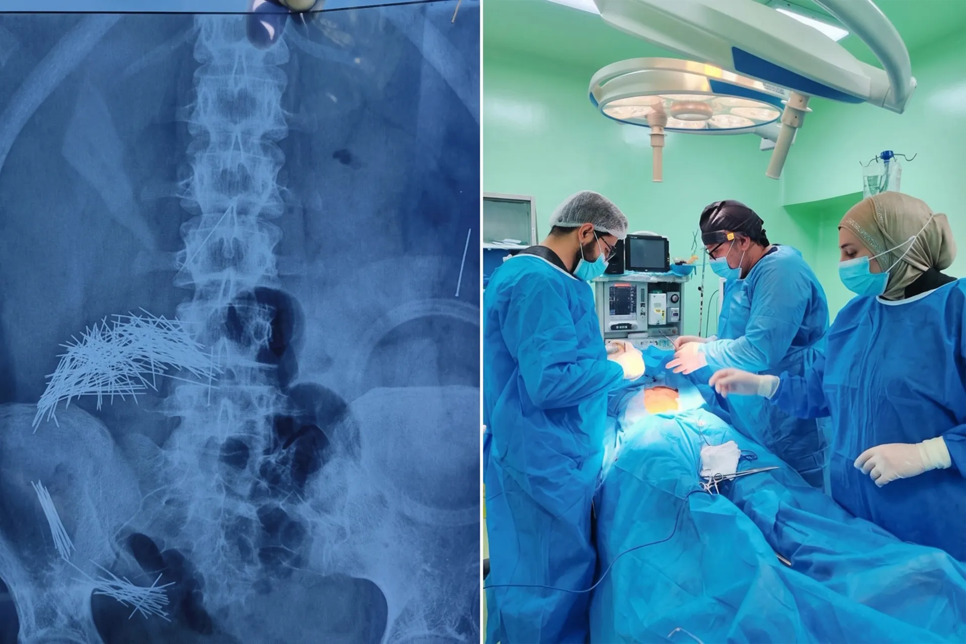 Trauma in the gut of an Iraqi...a complex surgery to extract 214 needles and pins from his stomach